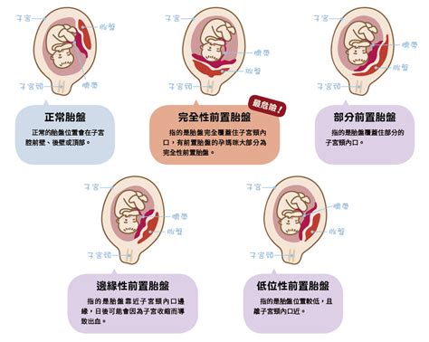 前置胎盤原因|前置胎盤有4種，一張圖帶你秒懂｜Mombaby 媽媽寶 